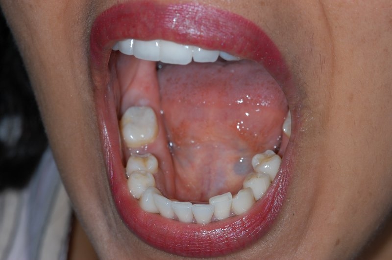 White filling - after treatment - Dentistry Hungary