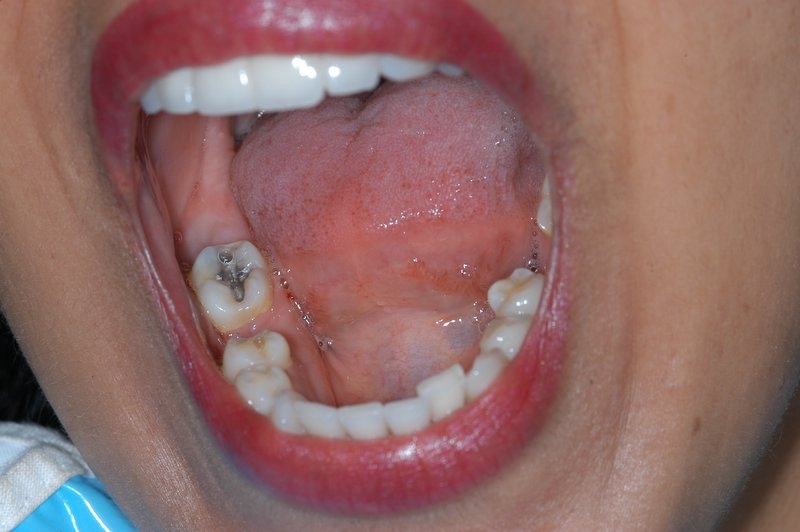 White filling - before treatment - Dentistry Hungary