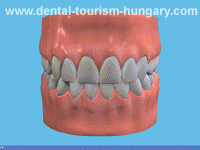 Tray whitening of the teeth - Tooth whitening in Hungary - Low costs and top quality
