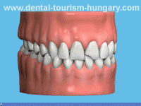 Bonding - Dental treatments in Hungary - top prices!