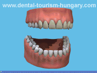 Tooth whitening procedure - Dental Tourism Hungary - Super Prices!