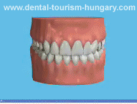 Changing Amalgam Fillings to Composite Fillings - Dentistry Hungary