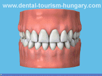 Get Dentures in Hungary for bargain Prices! - Dental Tourism Hungary