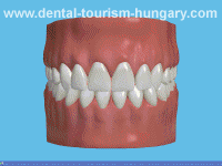 Surgical extraction of wisdom tooth - Dental Tourism Hungary