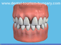Veneers for low costs at Dental Tourism Hungary