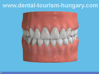 Preparation of a Zirconia crown - Good prices abroad - Dental Tourism Hungary