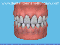 Root canal treatment in Hungary Mosonmagyarovar