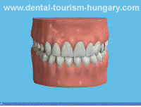Amalgam to composite filling