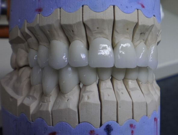 Zirconia crowns and bridges - Dentistry in Hungary