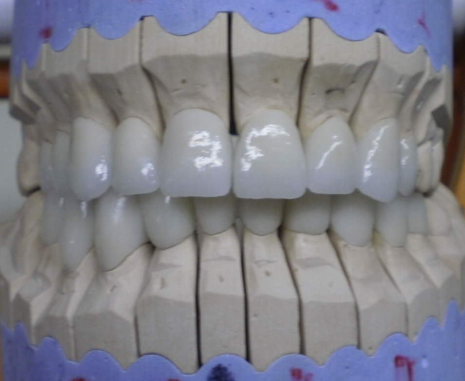 Zirconia crowns and bridges - Top Prices! - Dental Tourism Hungary