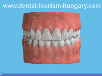 Preparation of a posterior crown