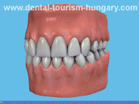 Dental problem of gum disease