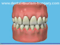 Sensitive teeth