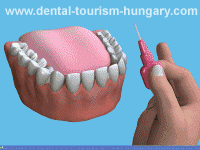 Interdental brush