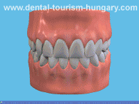 Tray whitening of the teeth