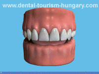 Dentures relining 