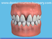 Veneers, ceramic shells in Hungary Mosonmagyaróvár