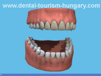 Tooth whitening procedure