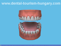 Preparation of a dental bridge