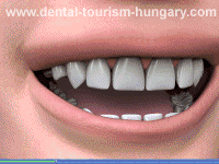 Tooth jewellery in Hungary Mosonmagyaróvár