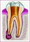Root canal treatment in Hungary