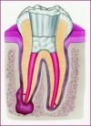 Root canal treatment in Hungary