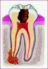 Root canal treatment in Hungary