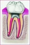 After root canal treatment in Hungary