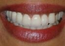 Dental bridge after the treatment