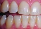 Before teeth whitening