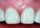 Veneer or ceramic shell