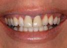 Before dental treatment
