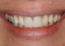 After dental treatment