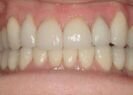 After dental treatment