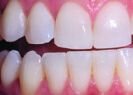 After teeth whitening