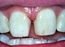 Big space between teeth