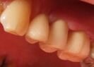 A 3-part circonium bridge