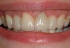 Ceramic crowns in Hungary Mosonmagyaróvár