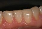 White filling