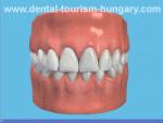 Dental bridges in Hungary Mosonmagyaróvár