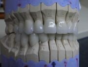 Zirconium crowns - low costs - Dentistry in Hungary - best prices abroad