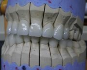 Dental crowns and bridges from zirconium-ceramic - best price - Dentistry in Hungary