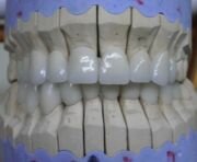 Zircounium Crowns - Bridges - Dentistry Abroad - best prices