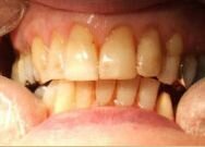 Zirconium Crowns - Low costs in Hungary (before)
