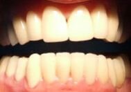 Zirconium-dioxid crowns - Dental Tourism Hungary - low costs (after)