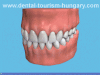 Dental implant and superstructure with bar, implant-supported bridge, implant-supported denture
