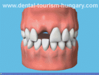 Placing the Implants - Dentistry in Hungary - Low cost Dental treatments abroad