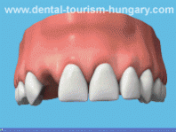 Temporary crown on an Implant - Dental Implantology in Hungary