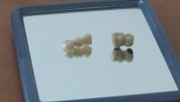 Differences between metal-ceramic and zirconium-ceramic crowns - Dentistry in Hungary